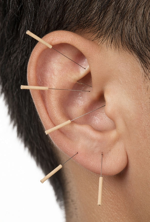 Diagram of acupuncture needles placed at points around the ear