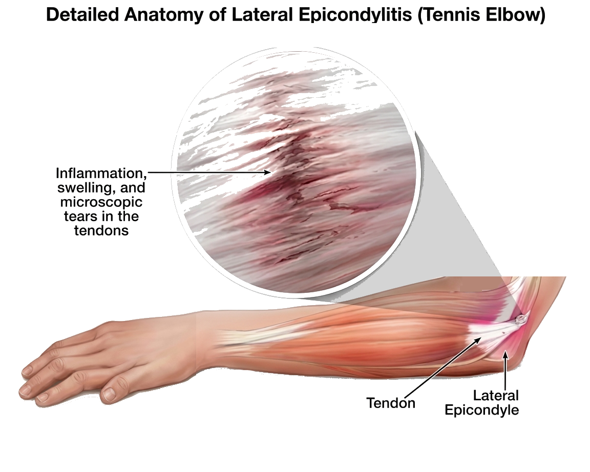 Diagram of tennis elbow inflammation at the lateral epicondyle