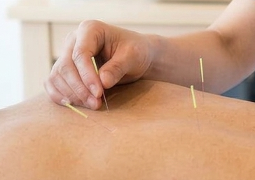 Acupuncture needles being placed along the back